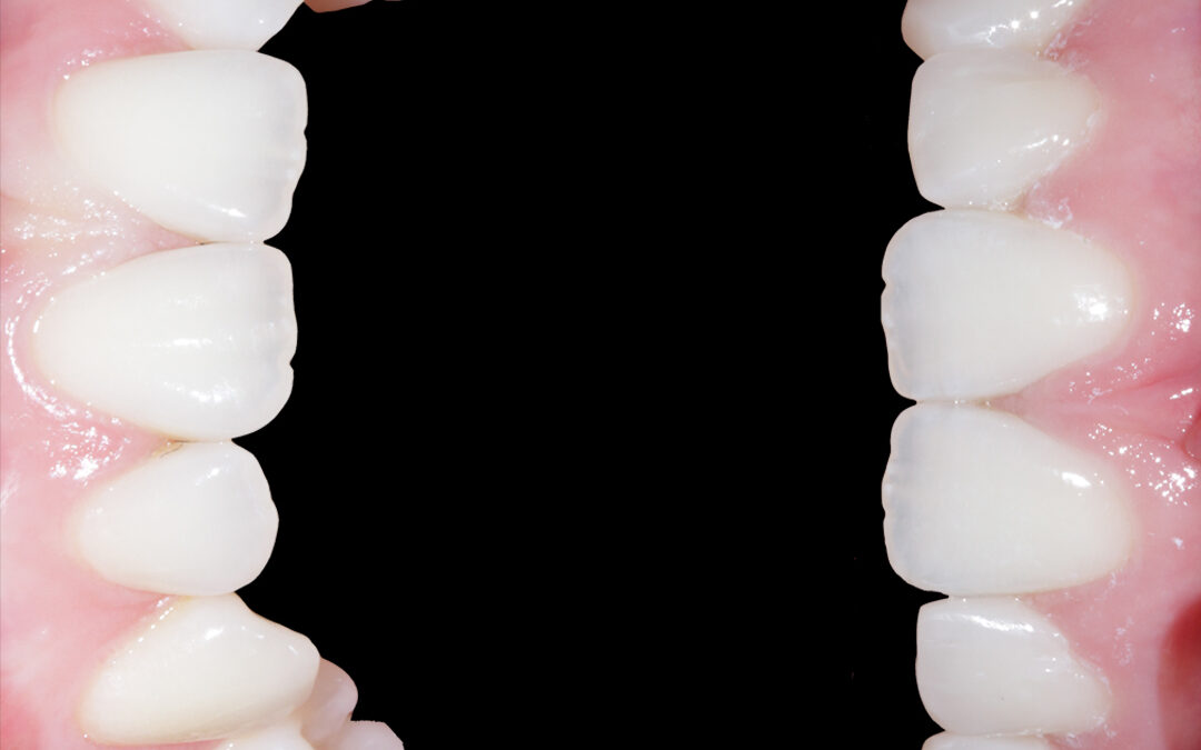 Composite Edge Bonding