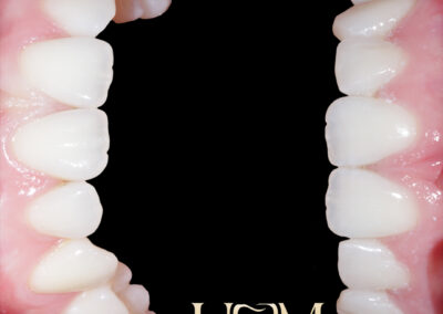 Composite Edge Bonding