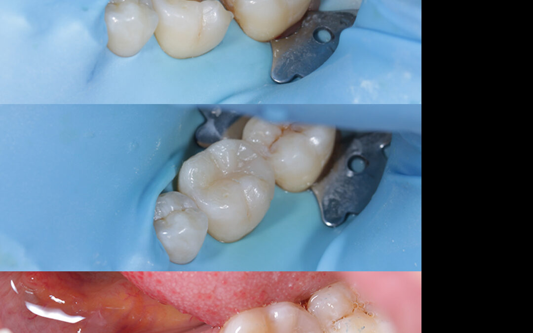 Lower Molar Composite Filling