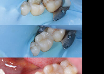Lower Molar Composite Filling