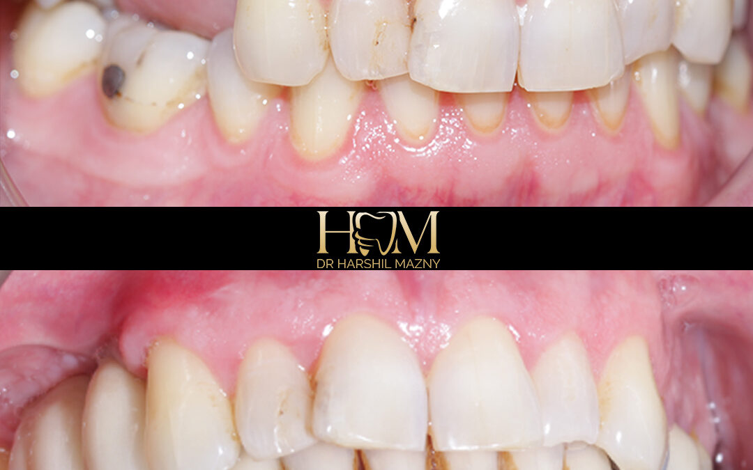 Implants with Bone Grafting and Sinus Lift