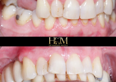 Implants with Bone Grafting and Sinus Lift