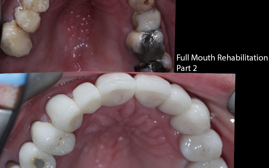 Full Mouth Rehabilitation