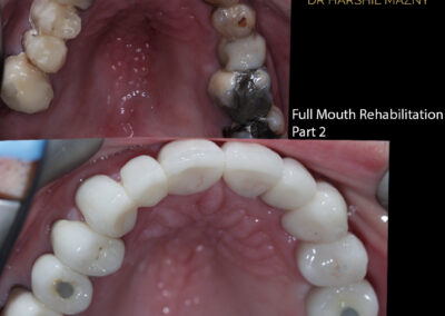 Full Mouth Rehabilitation