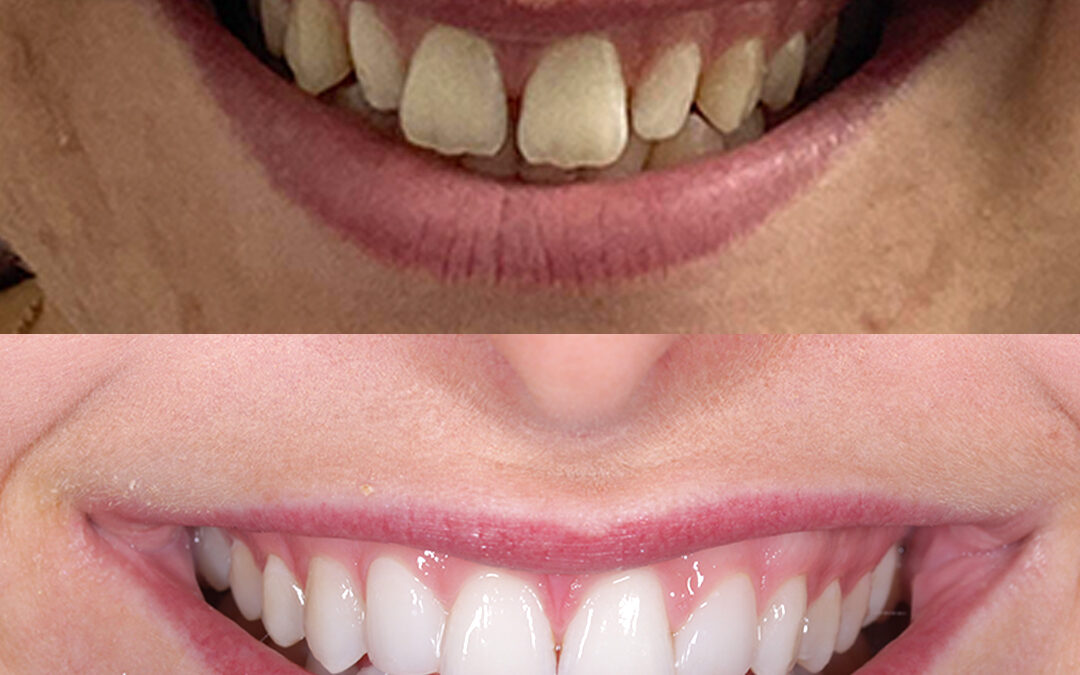 Invisalign, Composite Edge Bonding, Whitening