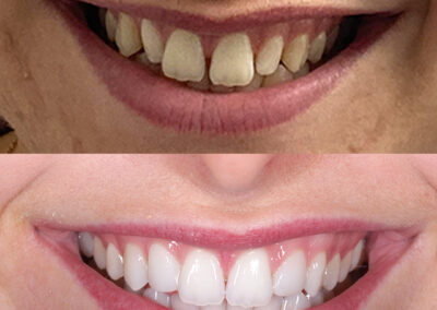 Invisalign, Composite Edge Bonding, Whitening