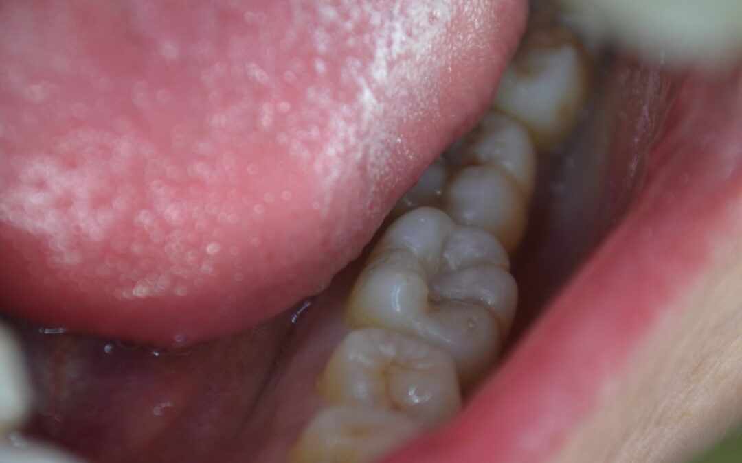 Simple Molar White Filling