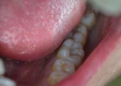 Simple Molar White Filling