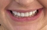 Invisalign and Composite Bonding