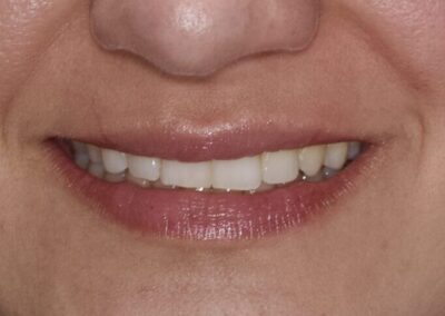 Invisalign, Composite Bonding