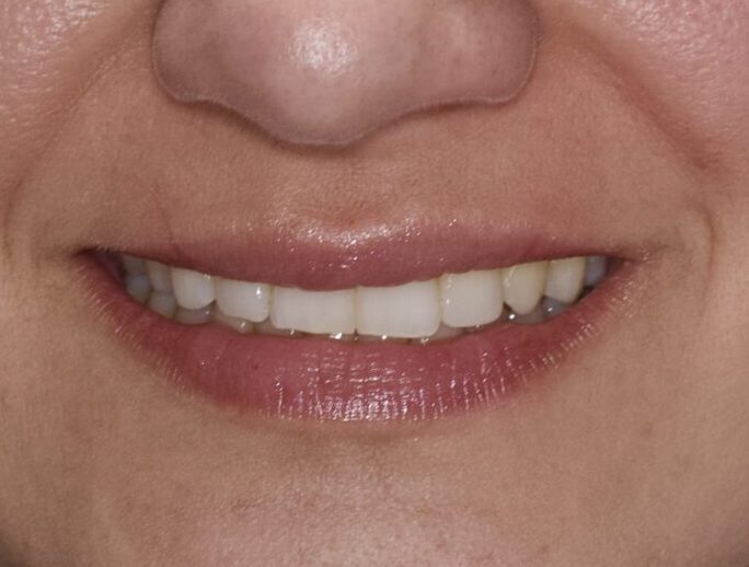 Invisalign, Composite Bonding