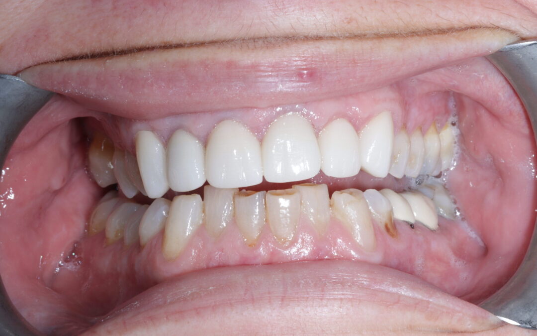Crowns and Veneers Anterior 6 teeth