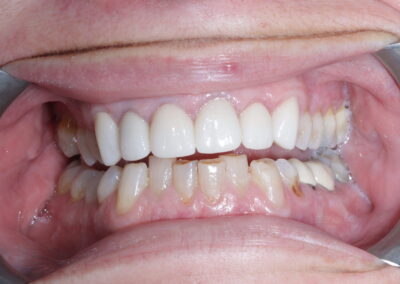 Crowns and Veneers Anterior 6 teeth