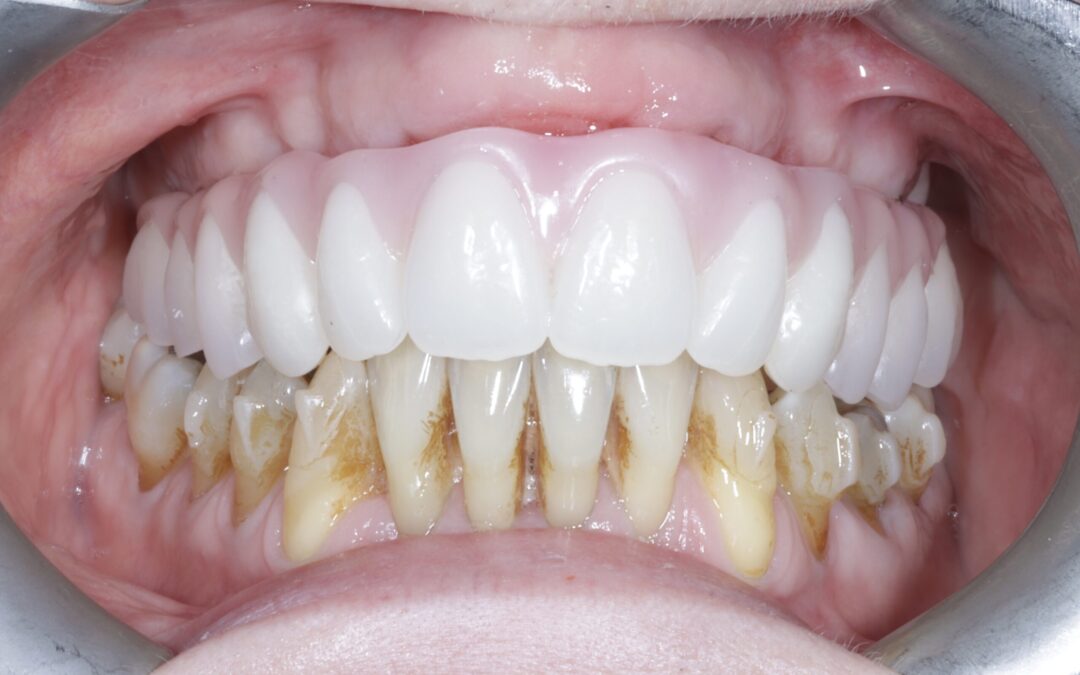 Full Mouth Rehab with Invis and Upper Full Arch Work