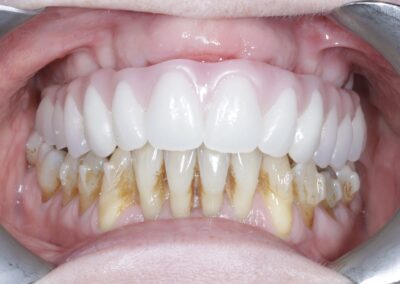 Full Mouth Rehab with Invis and Upper Full Arch Work