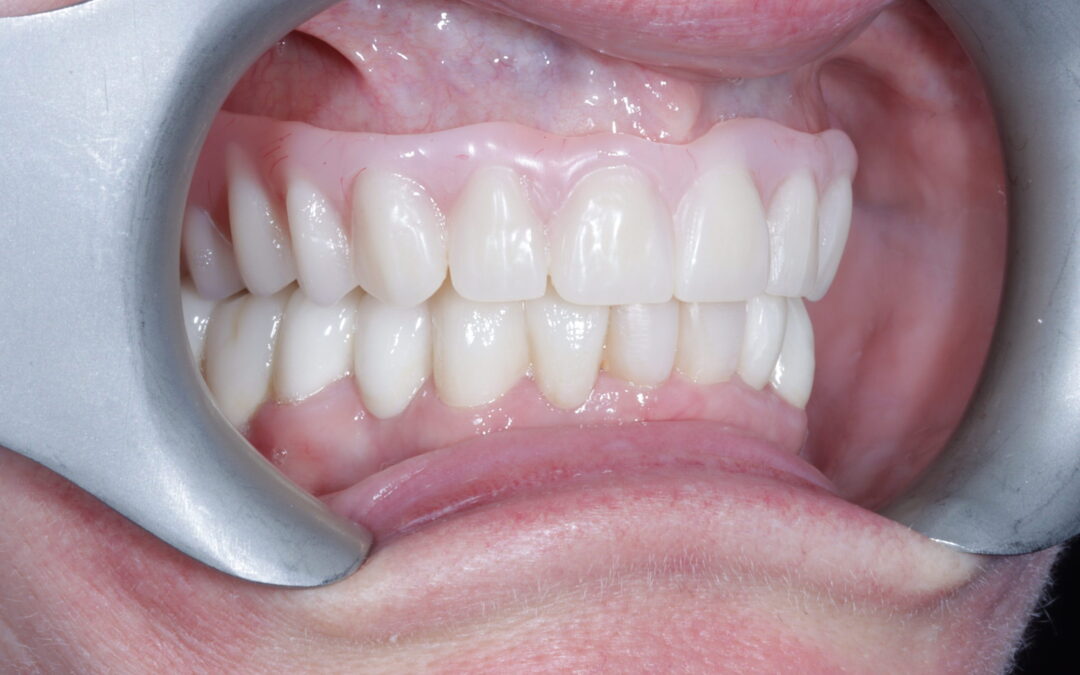 Full Mouth Rehabilitation with Upper Full arch work
