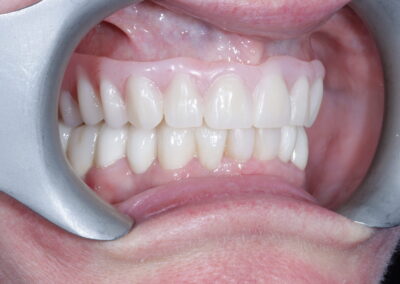 Full Mouth Rehabilitation with Upper Full arch work