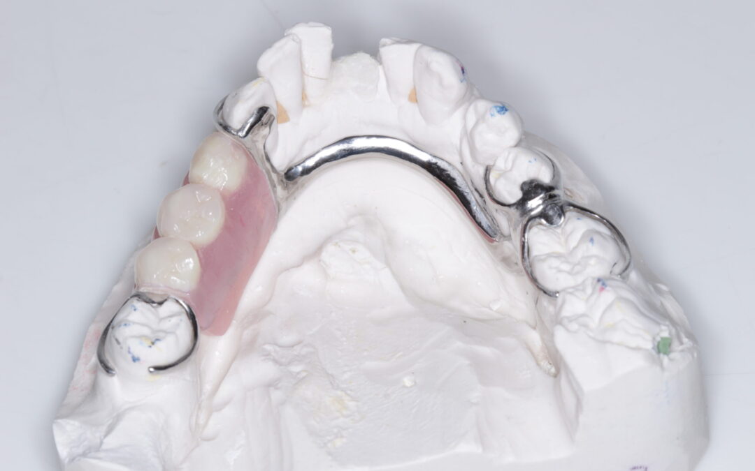 Removable Cobalt Chrome Dentures