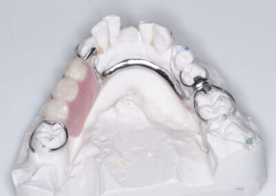 Removable Cobalt Chrome Dentures