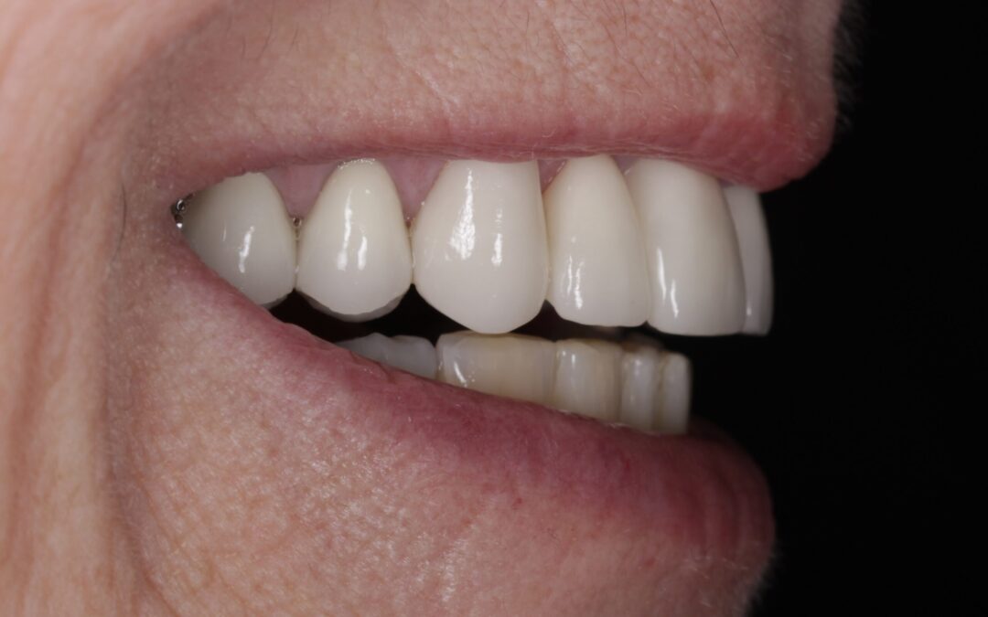 Crowns, Veneers and Bridgework