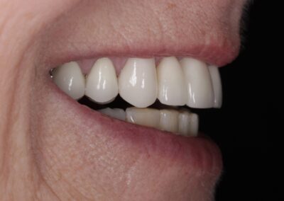 Crowns, Veneers and Bridgework