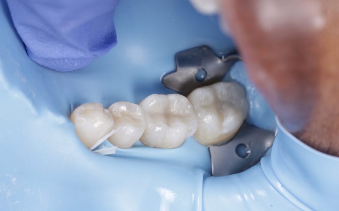 Composite Filling Molar
