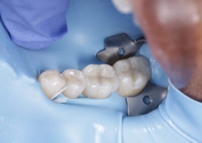 Composite Filling Molar