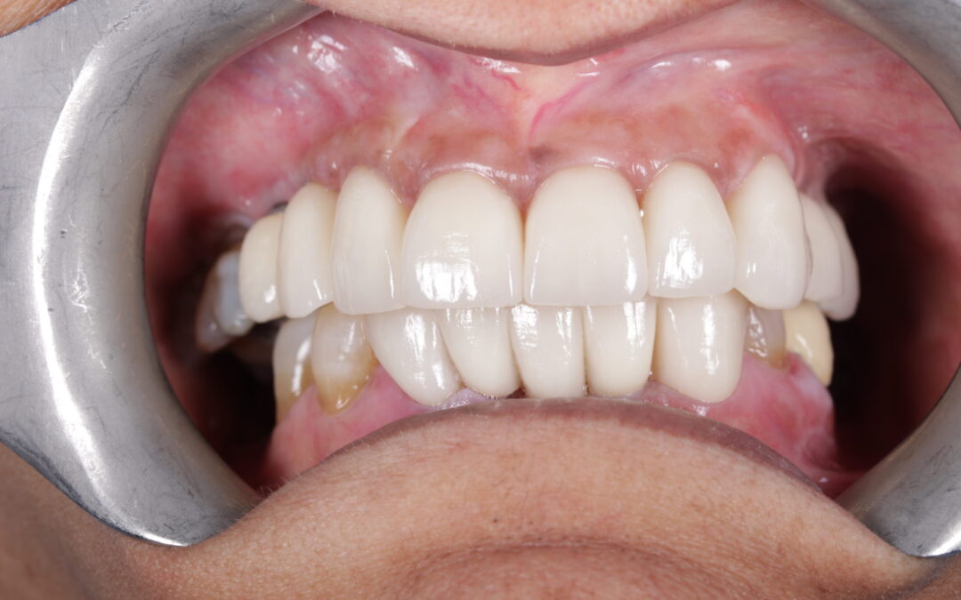 Full Mouth Rehabilitation 2