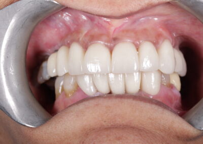 Full Mouth Rehabilitation 2