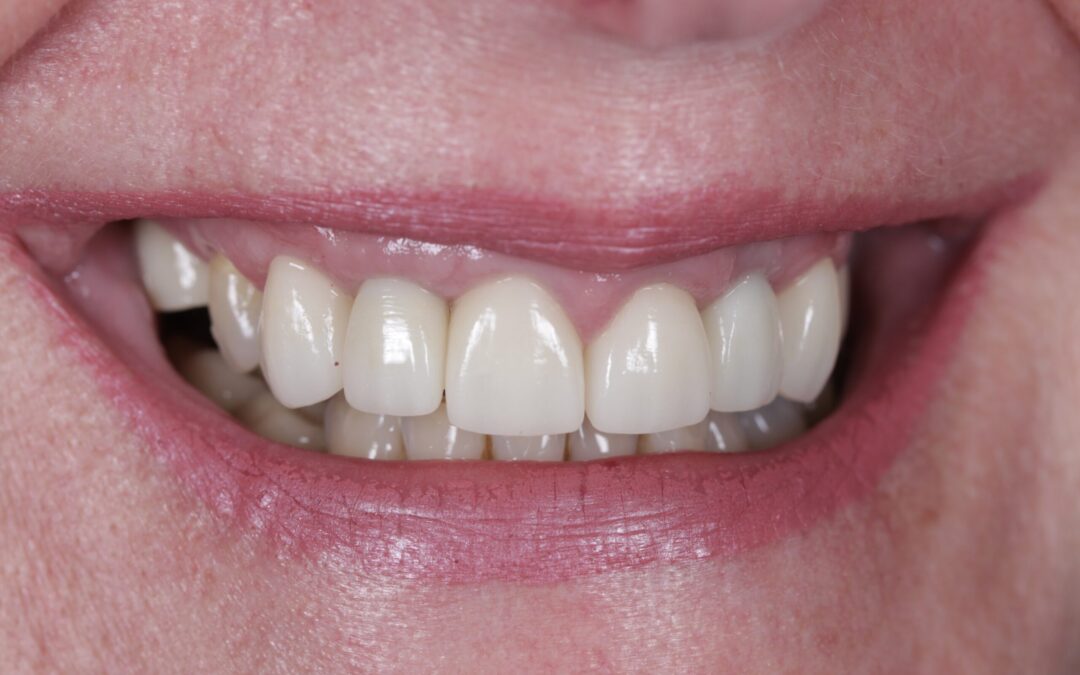 Implants, Crowns, Bridgework, Veneers