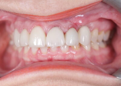 Implants, Crowns, Bridge, Veneers
