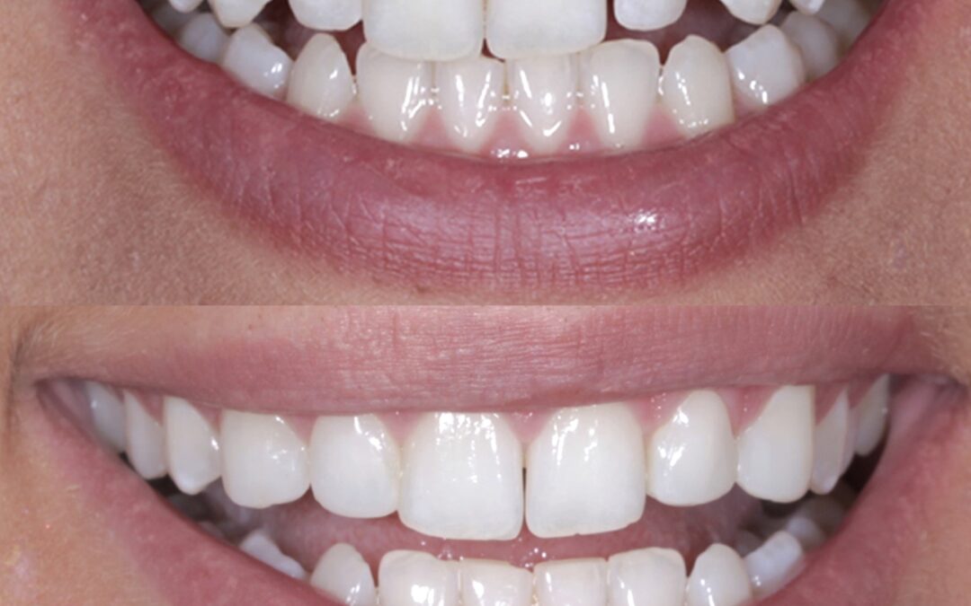 Minimal Composite Bonding