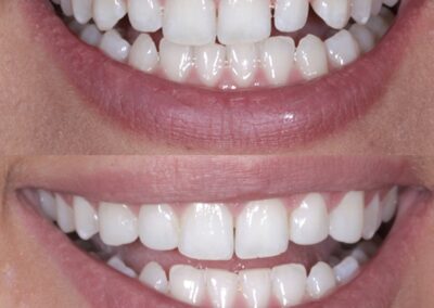 Minimal Composite Bonding